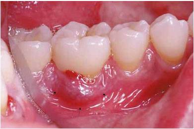 nguy co gay benh nha chu 01