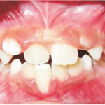 nguyen nhan can cheo rang truoc tre em