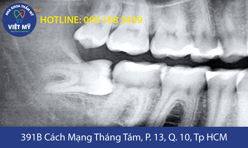 nha khoa tham my viet my nho rang khon