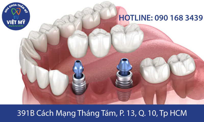 nha khoa tham my viet my trong rang su