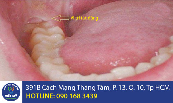 nha khoa tham my viet my vi tri tac dong rang khon